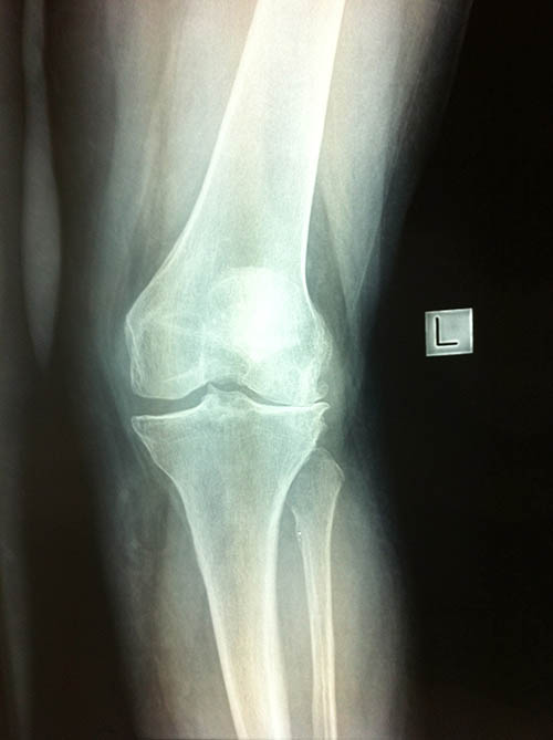 Xray Valgus Athritis