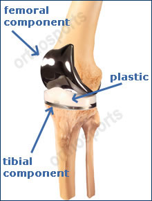 femoral component