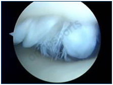 arthroscopy-10