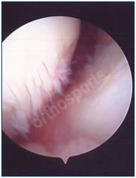 arthroscopy-6