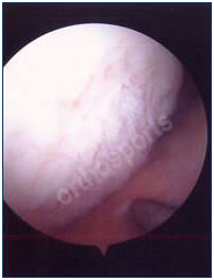 arthroscopy-7