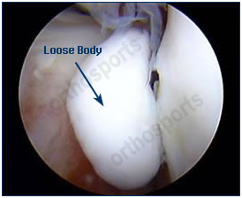 arthroscopy-8