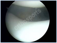 arthroscopy-9