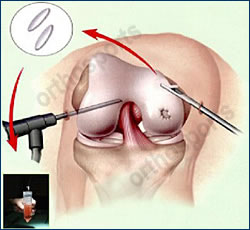 cartilage-6