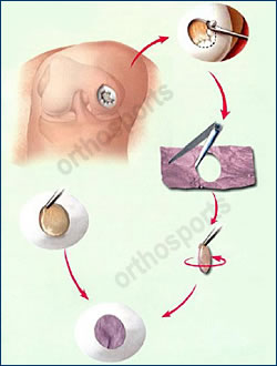 cartilage-7