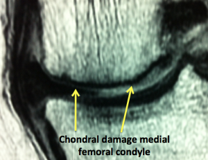 cartilage chondral damage MRI MACI cartilage graft