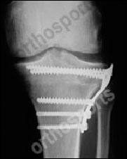 high-tibial-osteotomy