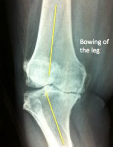 knee arthritis varus knee bowed leg bone on bone