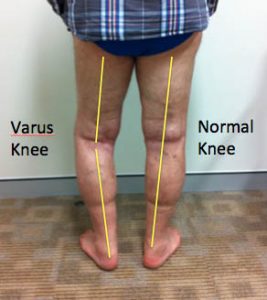 knee arthritis varus knee clinical photograph