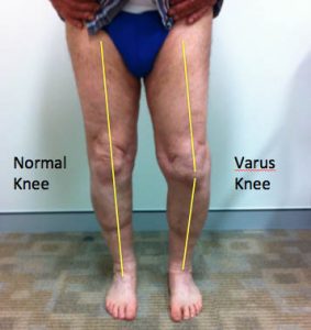 knee arthritis varus knee clinical photograph front view