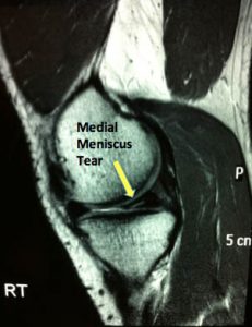 meniscus tear meniscal tear cartilage injury