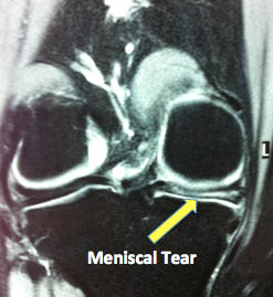 meniscus tear meniscal tear cartilage injury AP MRI