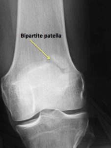 patella kneecap xray bipartite