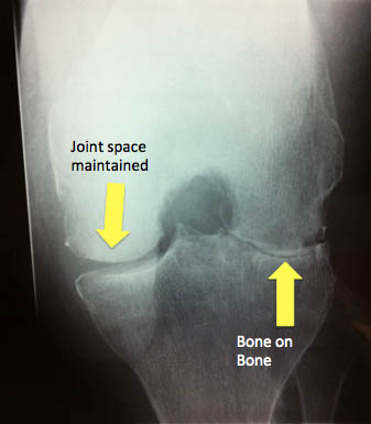 total knee replacement arthritis flexion view