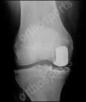 uni-knee-replacement-1