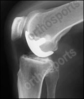 uni-knee-replacement-2